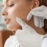 How to Remove Moles Naturally at Home