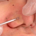 blackhead removal