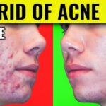 how to get rid of acne