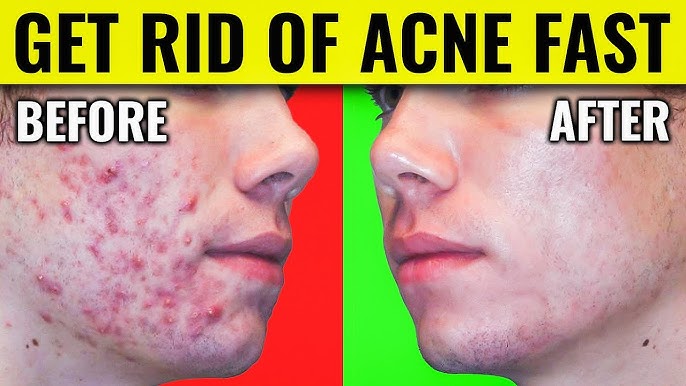 how to get rid of acne